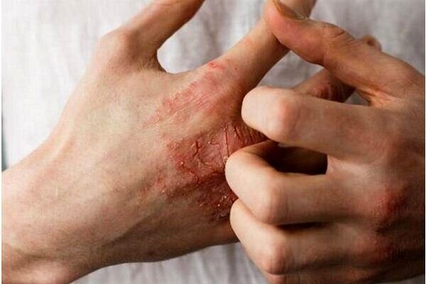 طاعون چطور منتقل می‌شود و چه علائمی دارد؟